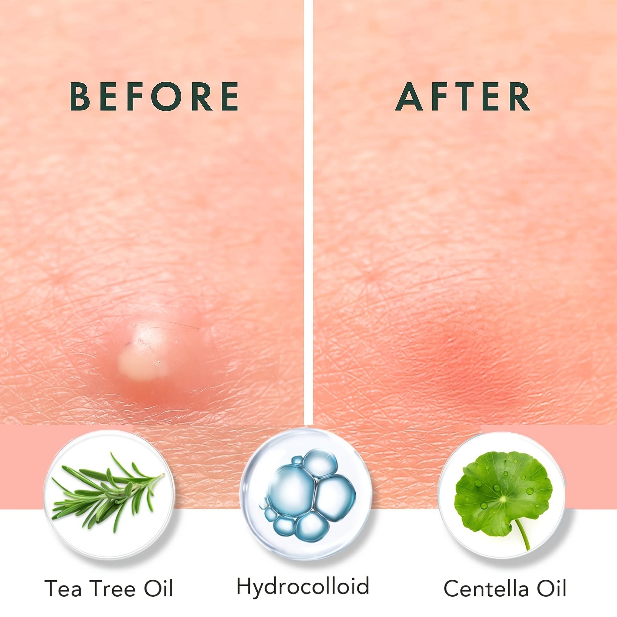 180/360/720개 여드름 패치, 수분 기반 젤,  - Skincare Oil Control 리뷰 및 가격